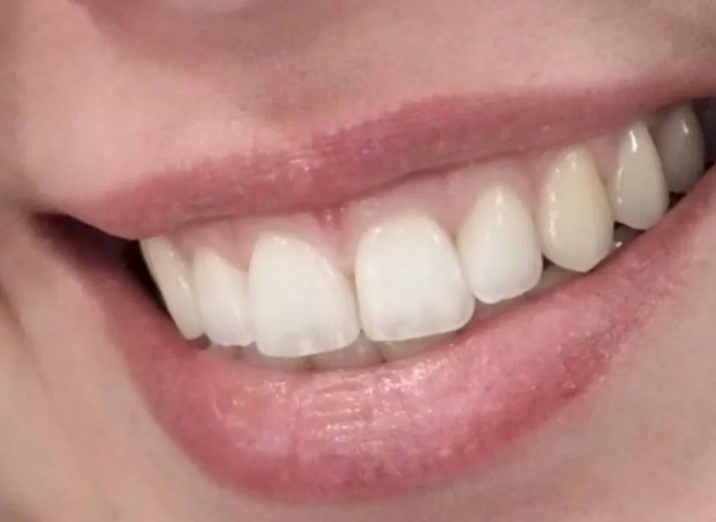 quanto dura il filler alle labbra