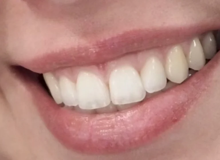 quanto dura il filler alle labbra