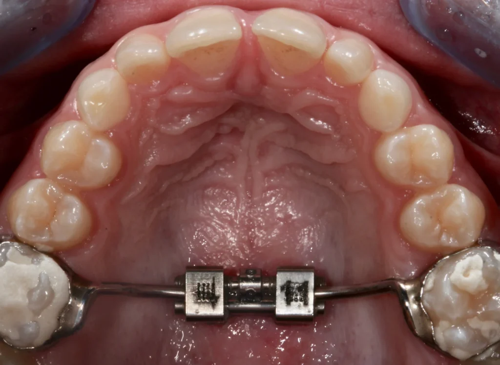 Come Lavare i Denti con l'Apparecchio: Guida Completa per Pazienti e Genitori 1 come lavare i denti con l'apparecchio