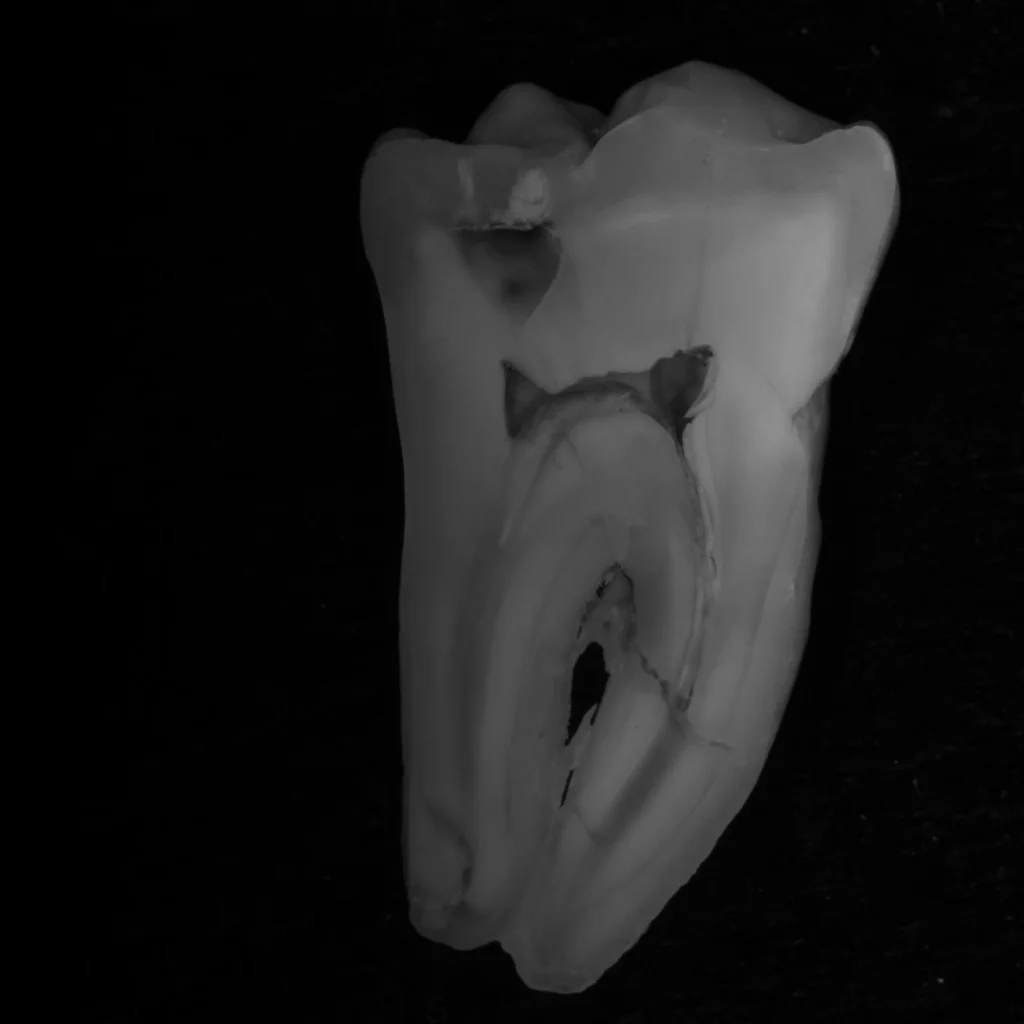 Endodonzia 1 devitalizzazione dente a milano porta romana