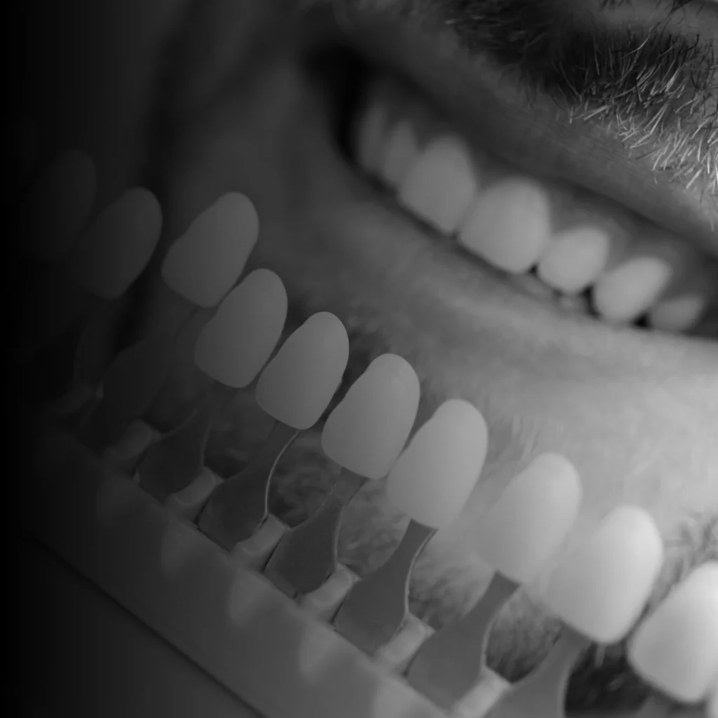 Faccette Dentali 1 faccette dentali a milano porta romana